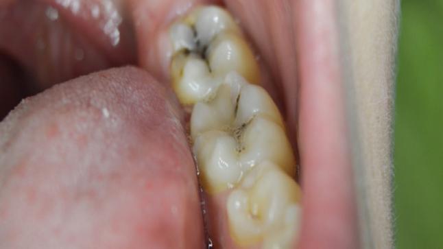 احصاء عند الجمعيا ت التسوس ينخر أسنان في مختلف أنحاء العالم.